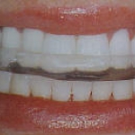 Dentistas em Santos - Thumb - Entenda mais o que é o bruxismo