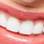 Dentistas em Santos - Thumb - Tratamento ortodôntico de mordida aberta!!