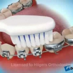 Dentistas em Santos - Thumb - Tudo sobre a higienização de Aparelhos Ortodônticos