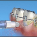 Dentistas em Santos - Thumb - Você conhece o Water Pik?