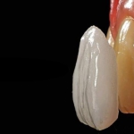 Dentistas em Santos - Thumb - Você já ouviu falar sobre Lente de contato dental?