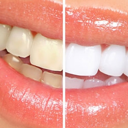 Dentistas em Santos - Clareamento