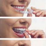 Dentistas em Santos - Thumb - Invisalign - O aparelho ortodôntico invisível