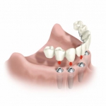 Dentistas em Santos - Thumb - O que é Carga Imediata