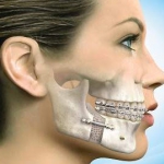 Dentistas em Santos - Thumb - O que é cirurgia Ortognática