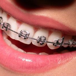 Dentistas em Santos - Ortodontia