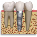 Dentistas em Santos - Thumb - Por que o implante dental está na moda?