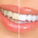 Dentistas em Santos - Thumb - Tudo que você precisa saber sobre clareamento a laser